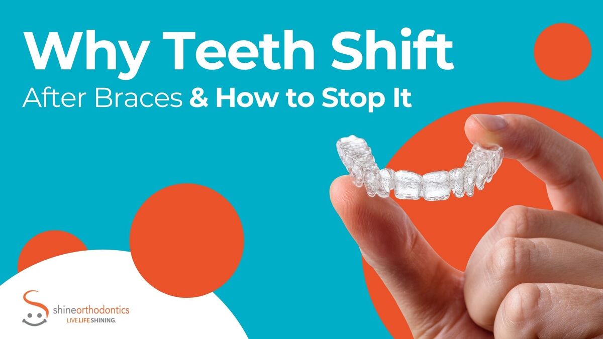 Why Teeth Shift After Braces and How to Stop It